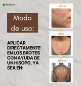 Bálsamo Anti-Acné Natural para Barros y Espinillas con Árbol de Té y Tepezcohuite – 60 ml
